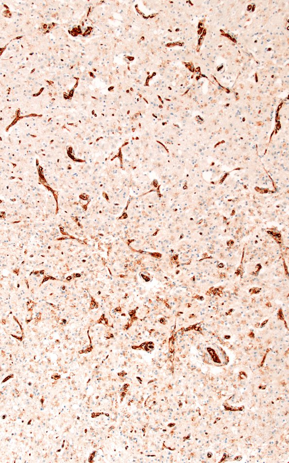 17D4 Wernicke syndrome (Case 17) N13 CD31 20X