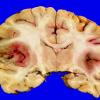 17F1 Wernicke Syndrome (Case 17) Yellow _4