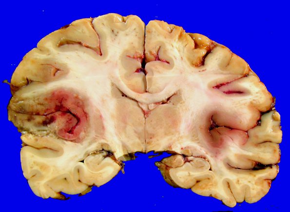 17F1 Wernicke Syndrome (Case 17) Yellow _4