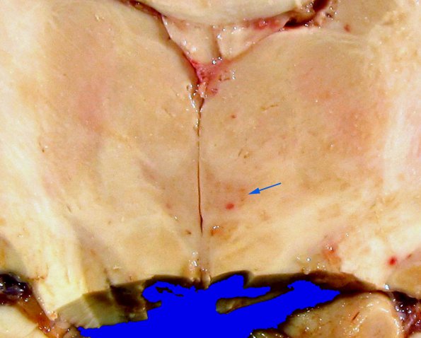 17F2 Wernicke Syndrome (Case 17) Yellow _4 copy