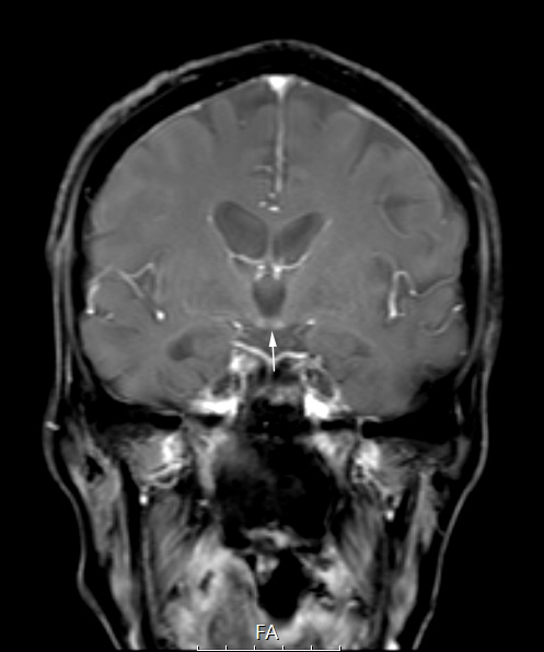 18A1 (Case18) Wernicke FL2D T1 FS POST contrast copy