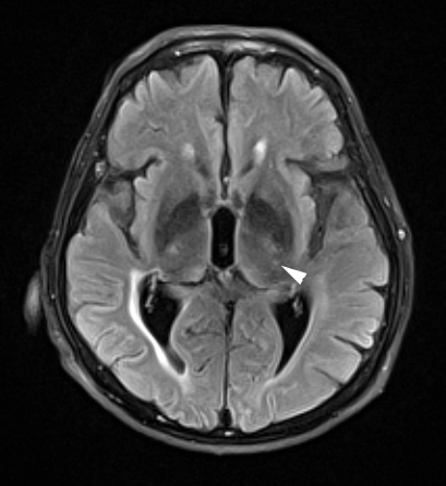 18A2 (Case 18) Wernicke FLAIR 2 copy