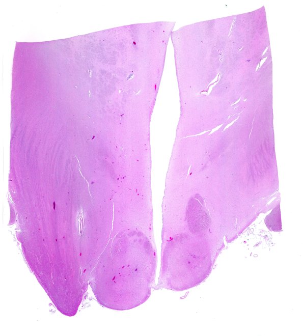 18C1 (Case 18)  Wernicke