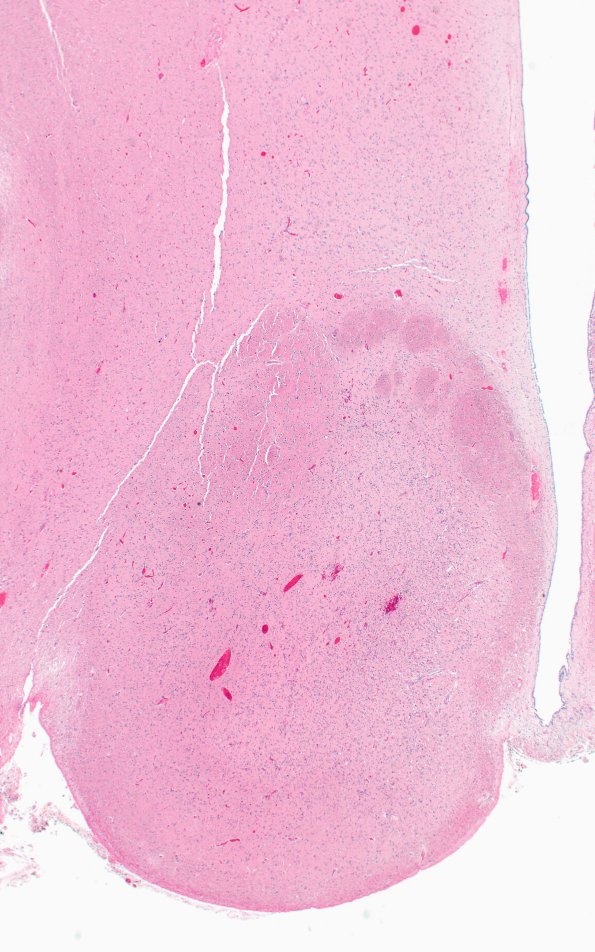 18C3 (Case 18)  Wernicke N11B H&E 2X 2