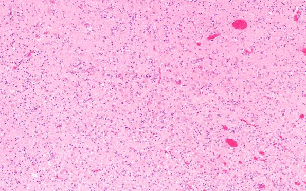 18C6 (Case 18)  Wernicke N11B H&E 10X