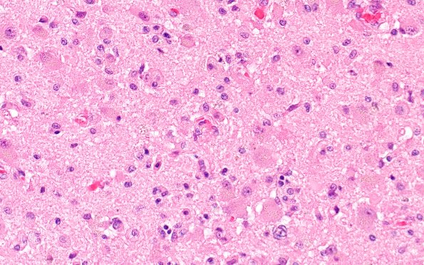 18C7 (Case 18) Wernicke N11B H&E 40X