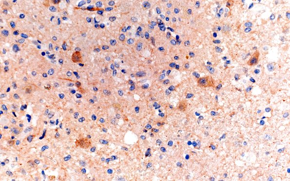 18D2 Wernicke (Case 18) NeuN 40X