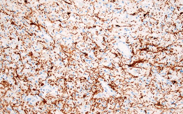 18E2 (Case 18) Wernicke N11A GFAP 20X