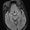 1A1 Wernicke Disease (Case 1) FLAIR Mammillary bodies copy - Copy