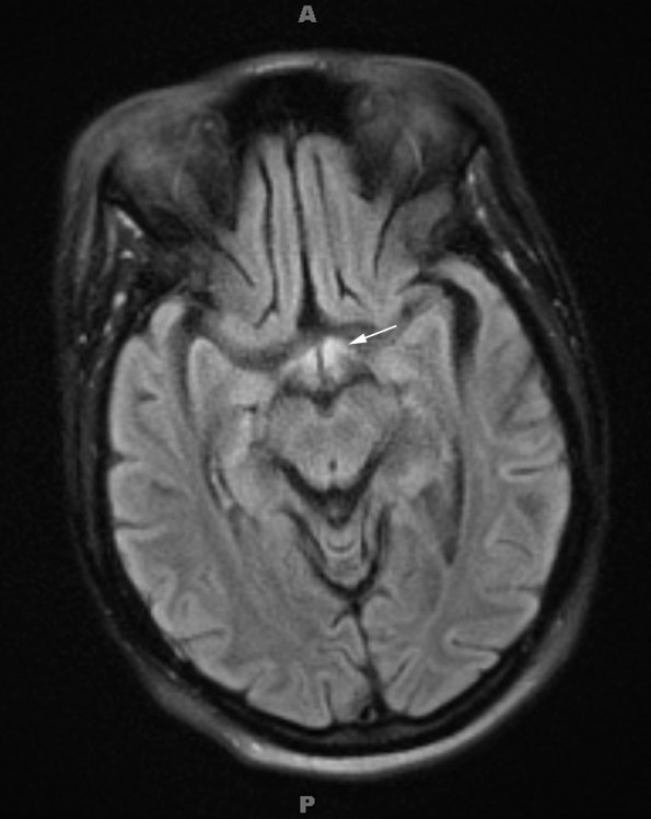 1A1 Wernicke Disease (Case 1) FLAIR Mammillary bodies copy - Copy