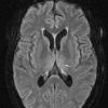 1A2 Wernicke Disease (Case 1) FLAIR Thalamus 1 copy - Copy