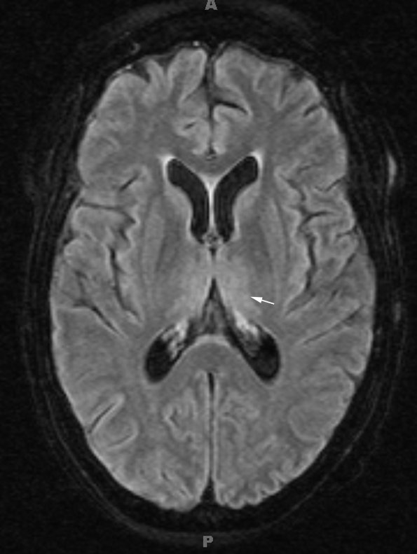 1A2 Wernicke Disease (Case 1) FLAIR Thalamus 1 copy - Copy