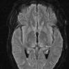 1A3 Wernicke Disease (Case 1) FLAIR Thalamus 2 copy - Copy