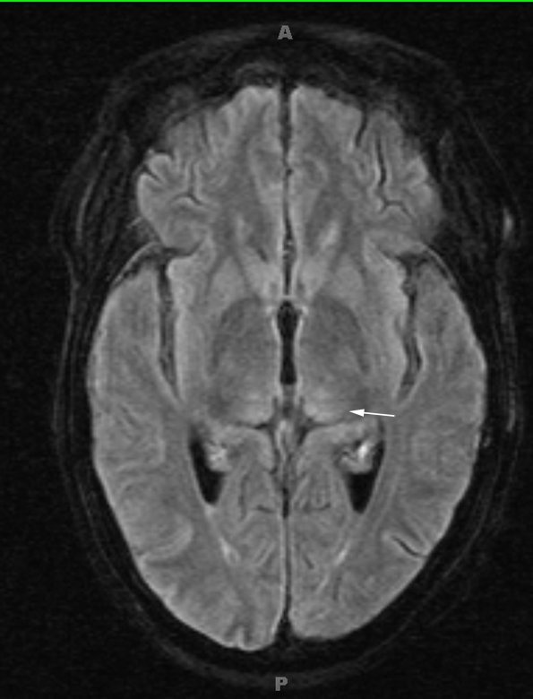 1A3 Wernicke Disease (Case 1) FLAIR Thalamus 2 copy - Copy