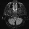 1A4 Wernicke Disease (Case 1) FLAIR Medulla T2 TRA TF 1 copy - Copy