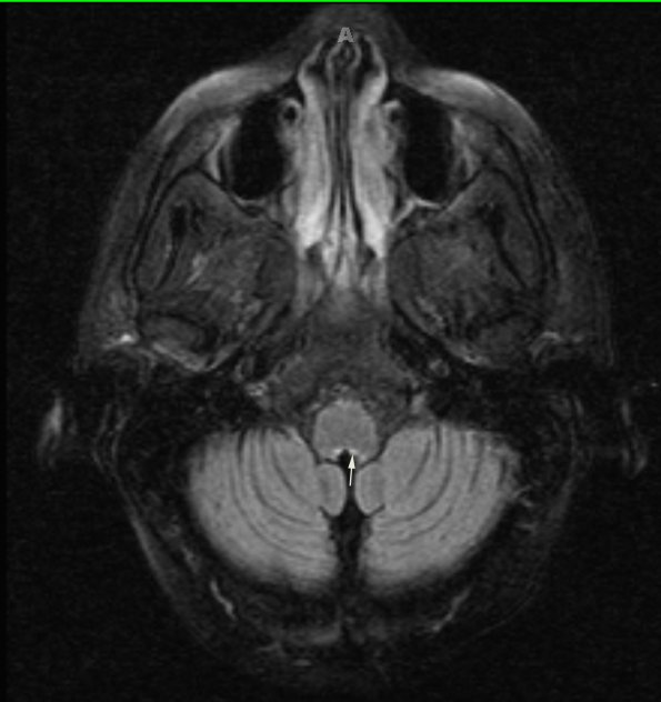 1A4 Wernicke Disease (Case 1) FLAIR Medulla T2 TRA TF 1 copy - Copy