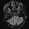 1A5 Wernicke Disease (Case 1) FLAIR Medulla copy - Copy