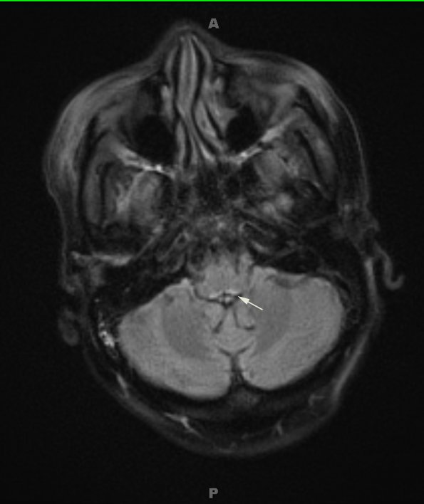 1A5 Wernicke Disease (Case 1) FLAIR Medulla copy - Copy