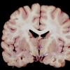 1B1 Wernicke's Encephalopathy (Case 1) 22 copy