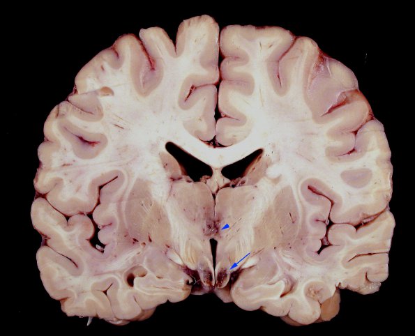 1B1 Wernicke's Encephalopathy (Case 1) 22 copy