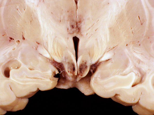 1B2 Wernicke's Encephalopathy (Case 1) 20