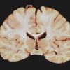 1B4 Wernicke's Encephalopathy (Case 1) 24