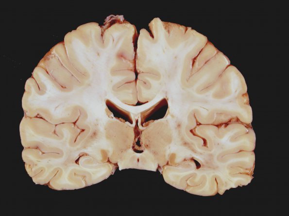 1B4 Wernicke's Encephalopathy (Case 1) 24