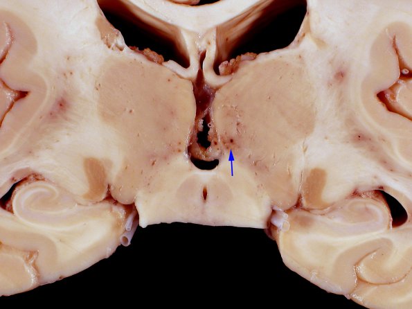 1B5 Wernicke's Encephalopathy (Case 1) 25 copy