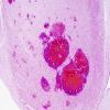 1C2 Wernicke's Encephalopathy (Case 1) 9 MB