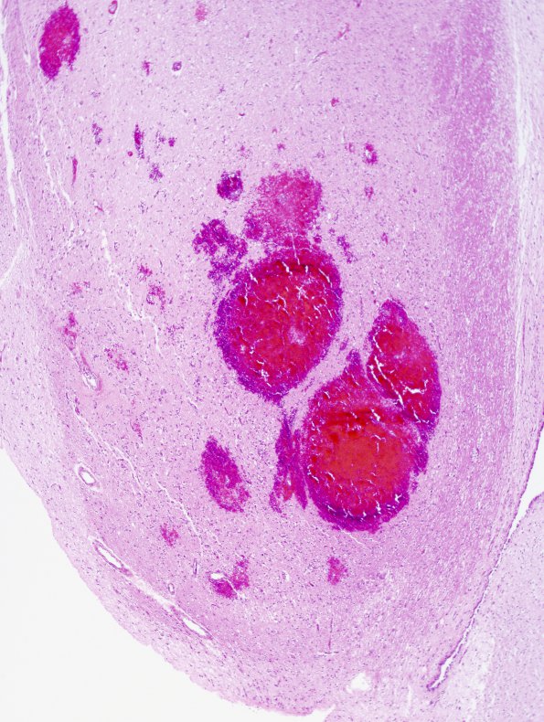 1C2 Wernicke's Encephalopathy (Case 1) 9 MB