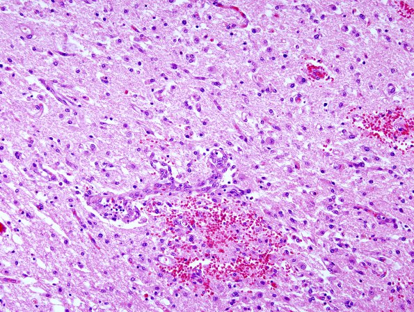 1C3 Wernicke's Encephalopathy (Case 1) 5 MB