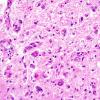 Filename:	 1C4 Wernicke's Encephalopathy (Case 1) 11