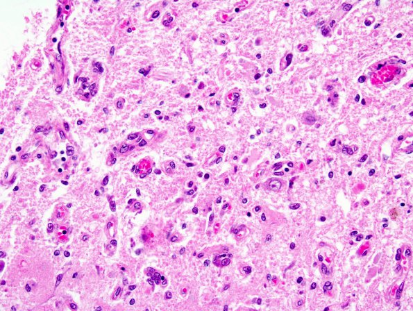 Filename:	 1C4 Wernicke's Encephalopathy (Case 1) 11