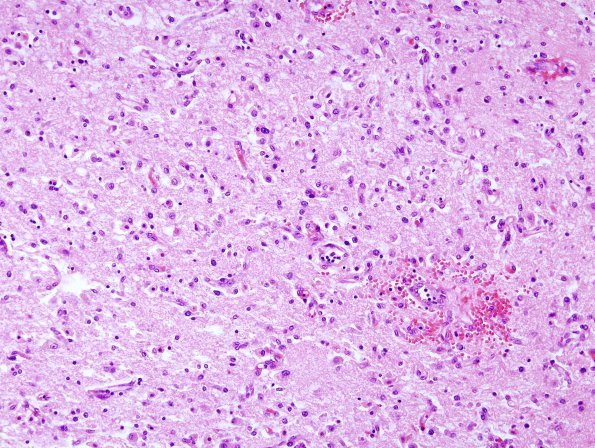 1C5 Wernicke's Encephalopathy (Case 1) 7 MB