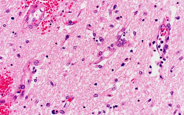 1C6 Wernicke's Encephalopathy (Case 1) N12 MB H&E 6