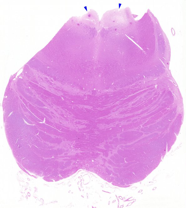 1D Wernicke's Encephalopathy (Case 1) 17 Pons copy A