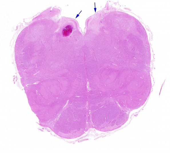 1E1 Wernicke's Encephalopathy (Case 1) 12 Medulla copy A