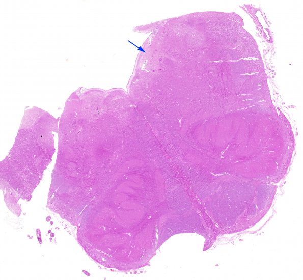 1E2 Wernicke's Encephalopathy (Case 1) 13 Medulla copy