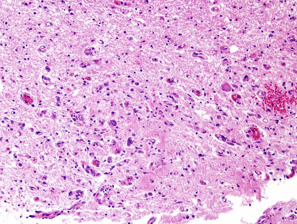 1E3 Wernicke's Encephalopathy (Case 1) 14 Medulla