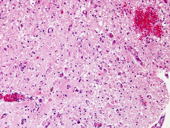 1E4 Wernicke's Encephalopathy (Case 1) 15 Medulla