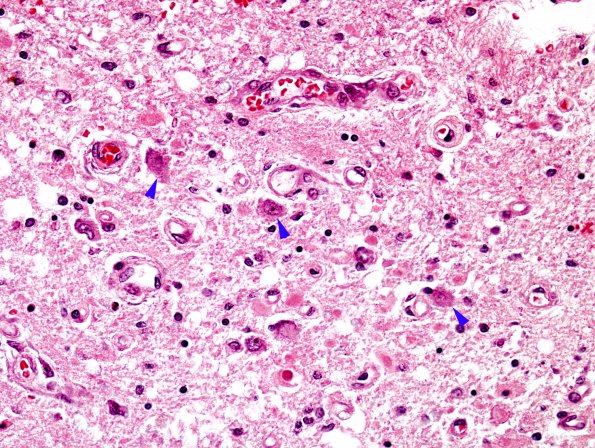 1E5 Wernicke's Encephalopathy (Case 1) 11 Medulla 2B copy