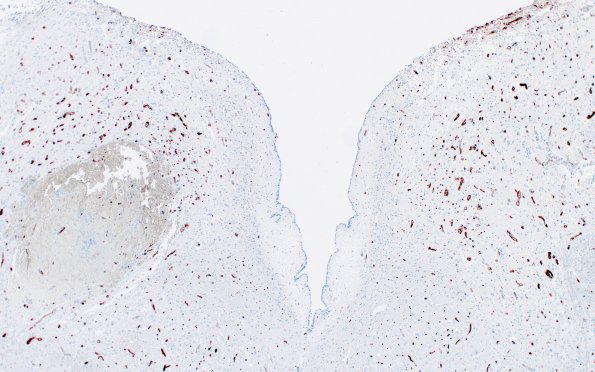 1E7 Wernicke's Encephalopathy (Case 1) N8 CD34 3