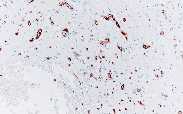 1E8 Wernicke's Encephalopathy (Case 1) N8 CD34 7