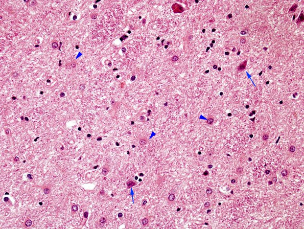 1F2 Wernicke's Encephalopathy (Case 1) 18 Thalamus copy copy