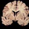 2A1 Caudate-Putamen Land Bridge (Wernicke Encephalopathy, Case 2) 1 (2)