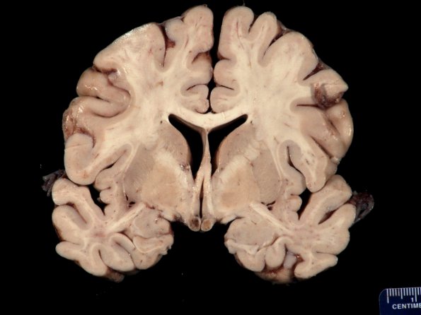 2A1 Caudate-Putamen Land Bridge (Wernicke Encephalopathy, Case 2) 1 (2)