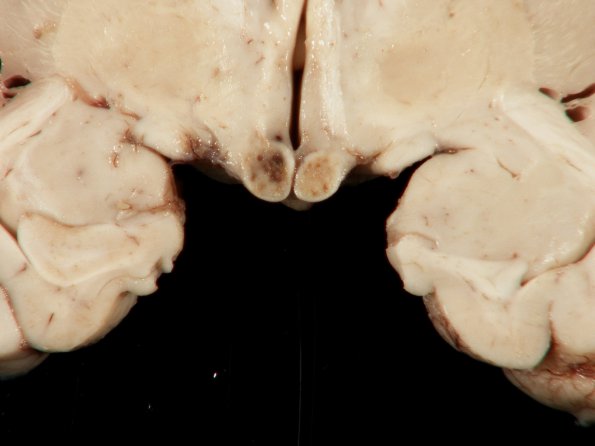 2A2 Wernicke Encephalopathy (Case 2) 2