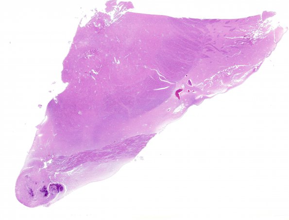 2B1 Wernicke Encephalopathy (Case 2) H&E whole mount