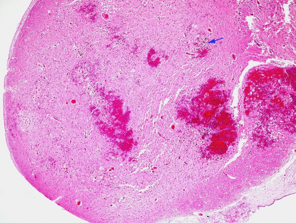 2B2 Wernicke Encephalopathy (Case 2) H&E 3 copy