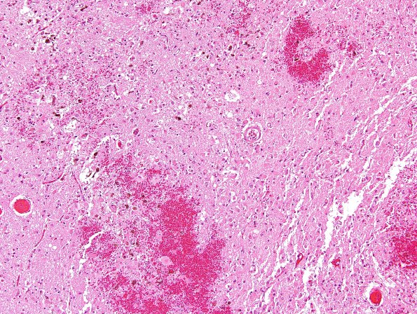 2B3 Wernicke Encephalopathy (Case 2) H&E 2